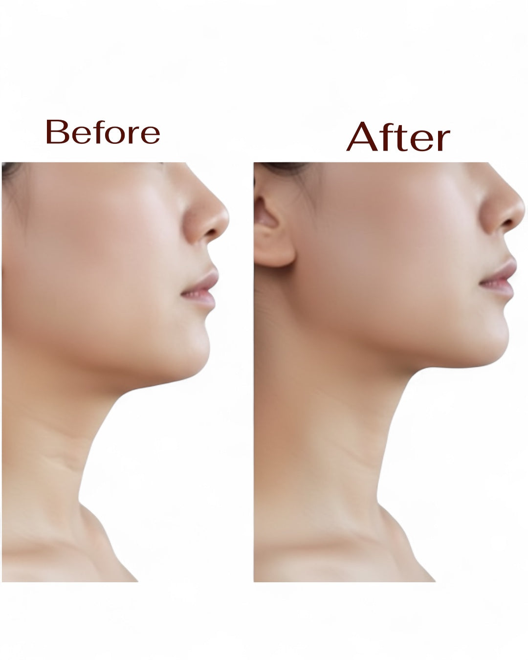 مشد لتنحيف الذقن والرقبة